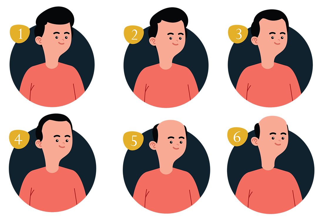 Reasons Why Men Experience Hair Loss